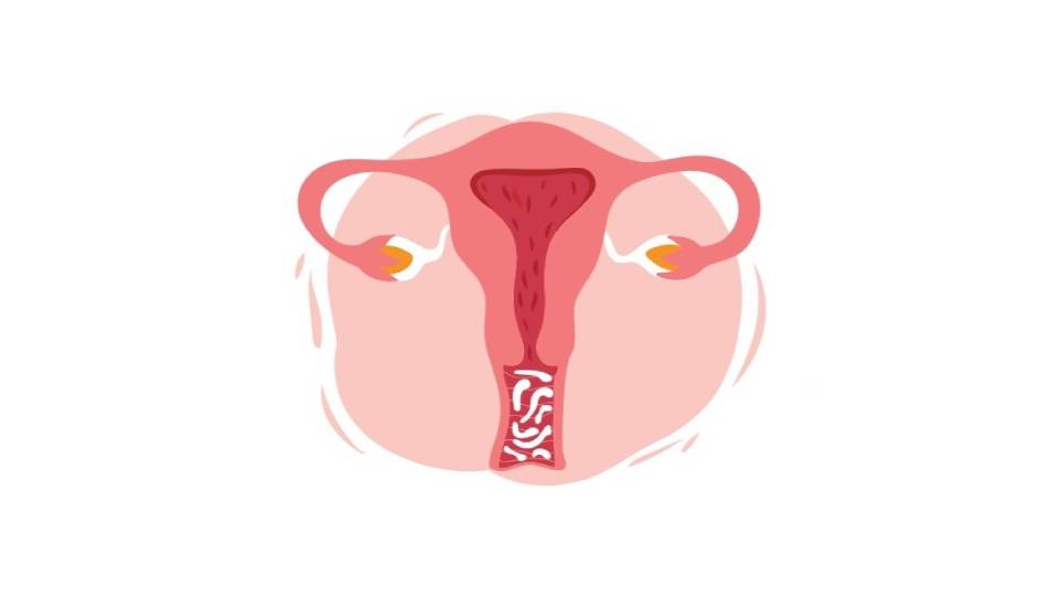 عفونت واژینان