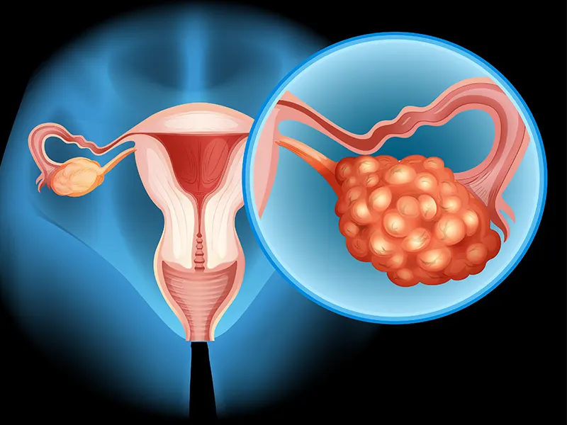 سرطان تخمدان