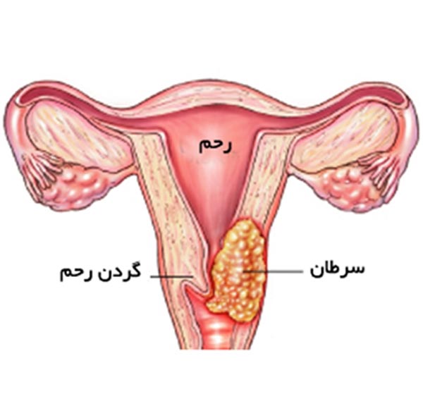 سرطان رحم