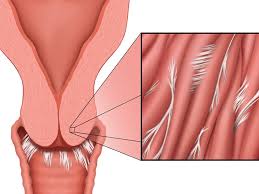 چسبندگی رحم