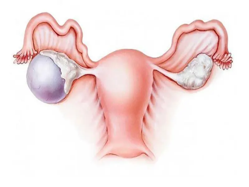 کیست تخمدان